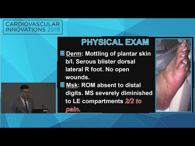 CVI2018 Session: Heparin Induced Thrombocytopenia - Preston Panicco