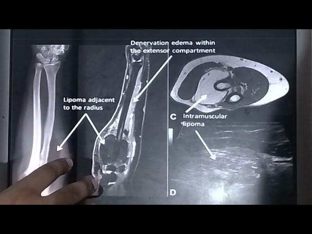 MRI NEUROGRAPHY, NEUROGRAPHY SEQUENCE