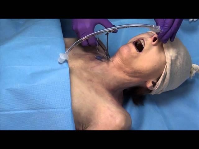 Retrograde Intubation