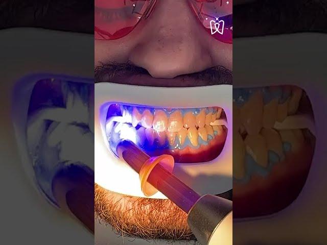 Teeth whitening process