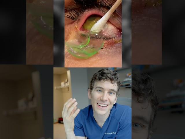 Removing 23 Contact Lenses Stuck in Eye Reaction