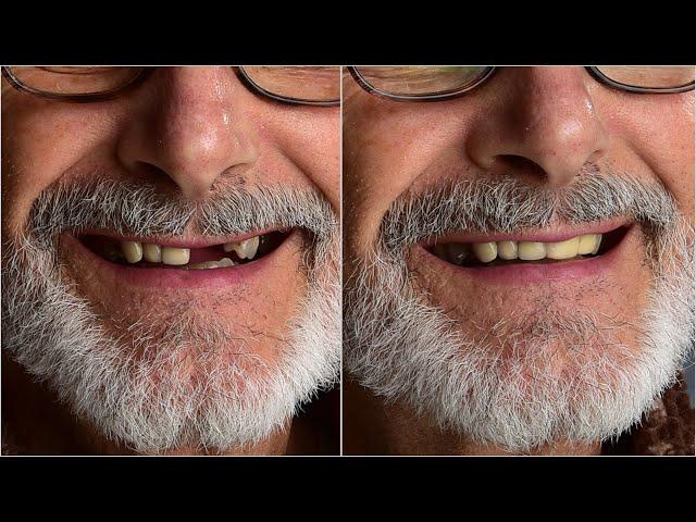 Temporary Missing Teeth Replacement