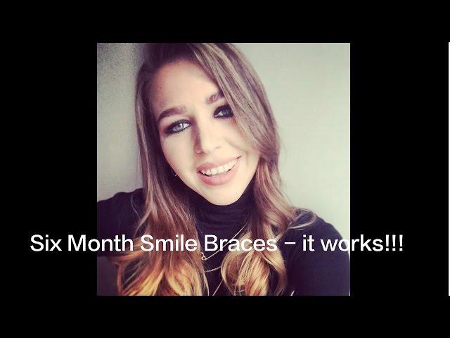 Six Month Smiles braces | Review |(my story) Your Questions answered