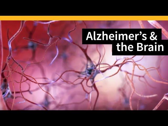 How Alzheimer's Changes the Brain