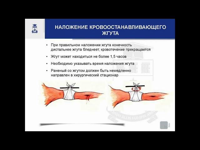 НАЛОЖЕНИЕ КРОВООСТАНАВЛИВАЮЩЕГО ЖГУТА