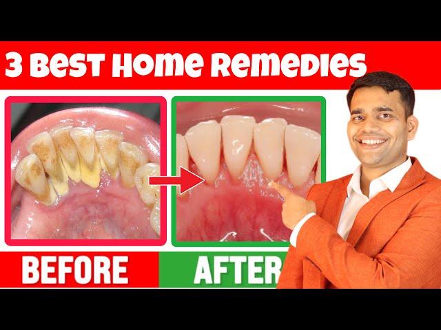 3 Remedies To Remove yellowness, Plaque, Cavities, and Gingivitis - Dr. Vivek Joshi