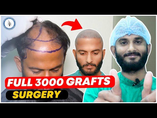 Hair Transplant in Ahmedabad | Cost of Hair Transplant in Gujarat | Grade 4 Baldness | 3000 Grafts