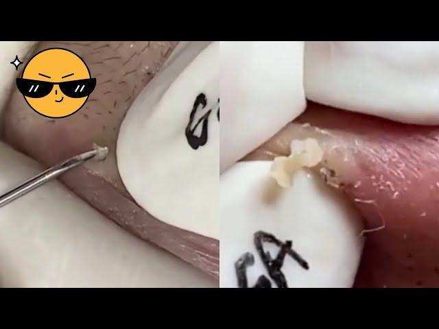 Popping Extravaganza: Ultimate Blackhead Removal and Pimple Popping