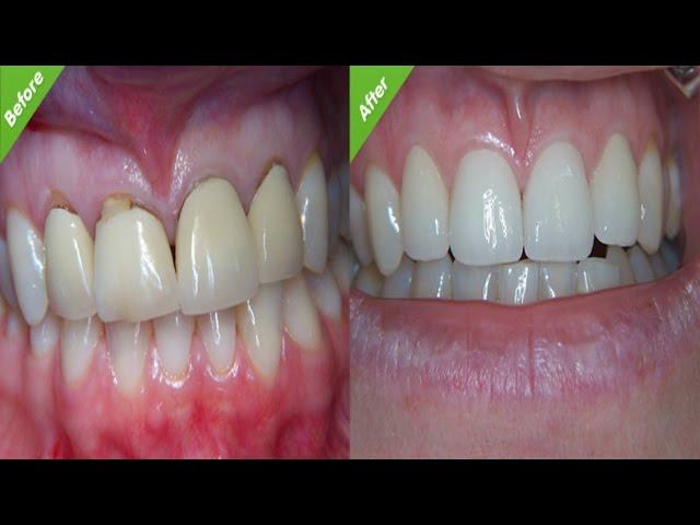 Post Root Canal Maintenance - Care World tv - Oral Health