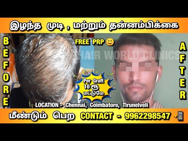 5 மாதத்தில் அருமையான ரிசல்ட் | Chennai, Coimbatore, Tirunelveli | Hair World Clinics