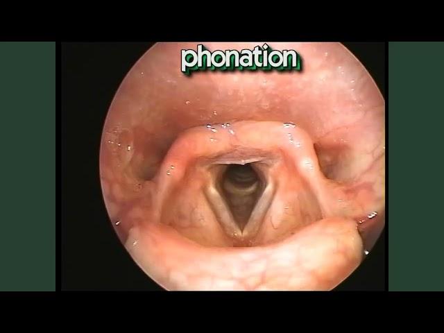 Vocal Cord Movements