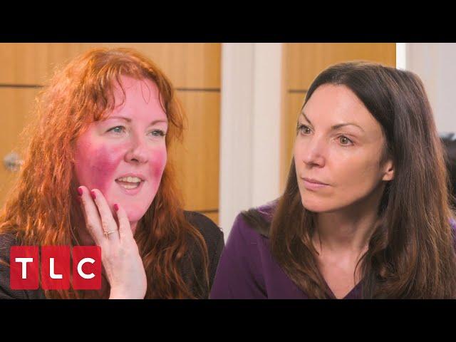 Emma's Rosacea Flares Red Hot | Save My Skin