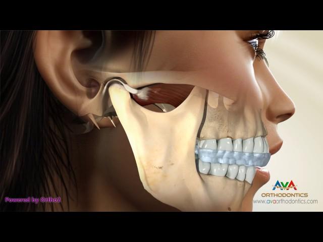 TMJ Occlusal Splint