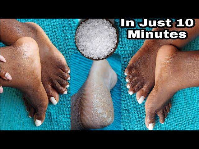 HOW TO REMOVE DEAD SKIN FROM YOUR FEET NATURALLY AT HOME 2021| CRACKED HEELS HOME REMEDY