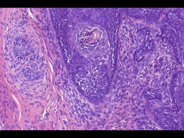 Trichoblastomatous tumors McKee& Kalmykova