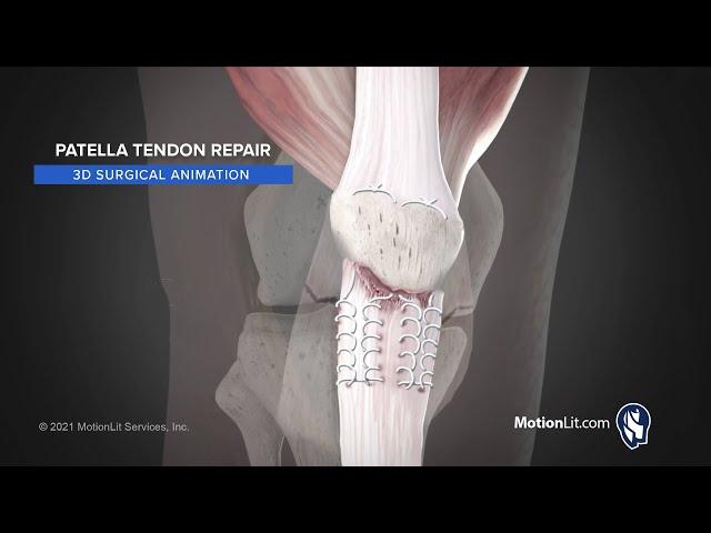 3D Surgical Procedure Depicts Complex Patella Tendon Repair