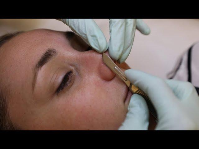 Dermaplaning facial resets your face with scalpels and acid | Glam Lab