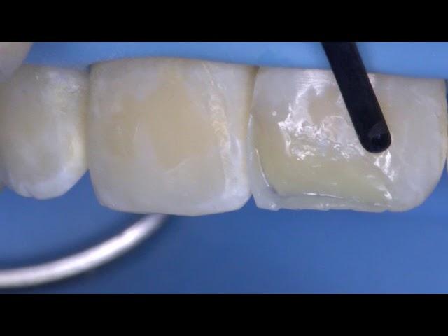 How to create an anterior restoration with multiple Mosaic composite shades