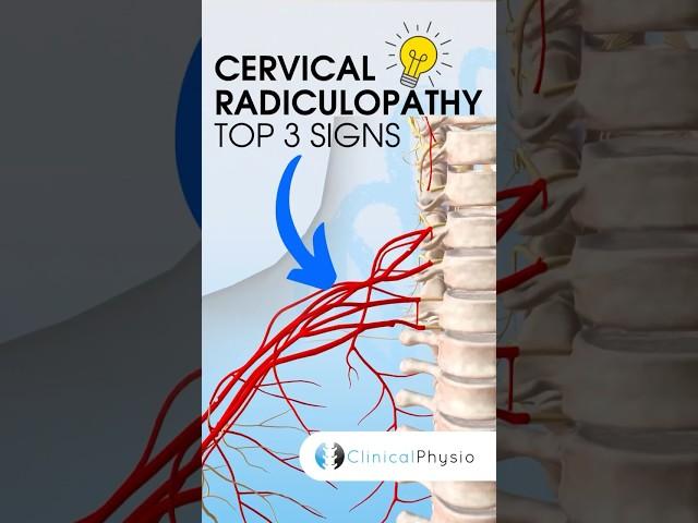 Cervical Radiculopathy Top 3 Signs #physiotherapy #physicaltherapy