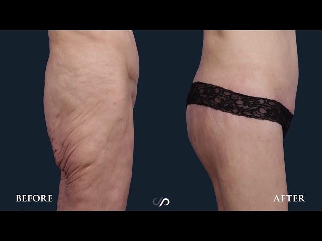 INCREDIBLE BODY LIFT TRANSFORMATION | Before and after |Dr. David Stoker