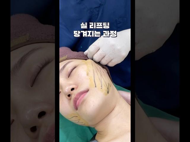 실 리프팅 당겨지는 과정 #실리프팅