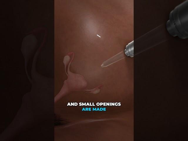 Removing fibroids from your uterus (3D Animation)