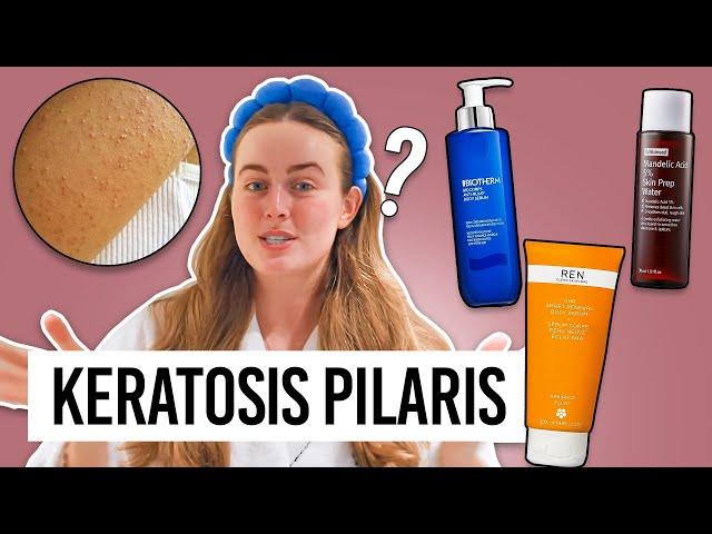 Goodbye Strawberry Legs & Keratosis Pilaris aka. Chicken Skin: Tips That Work! 