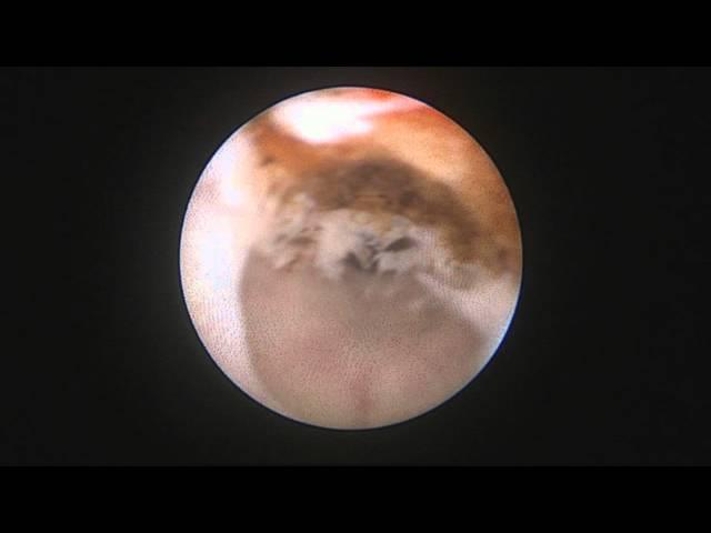 Laser urethrotomy. Dr Farid Gadimaliyev, Baku, Azerbaijan