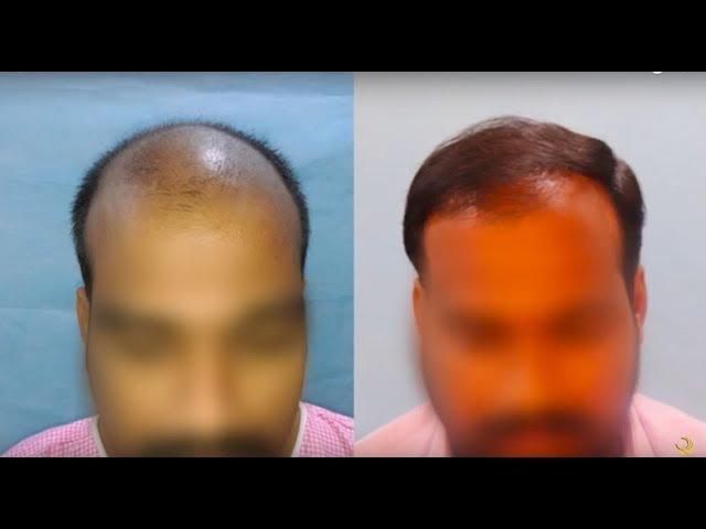 My Hair Transplant (2019) Results | 3554 Grafts | Stage 7 Baldness