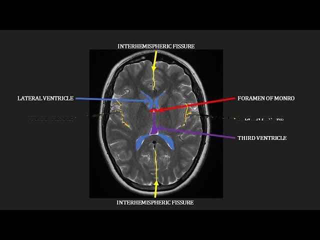 Introduction to MRI of the brain