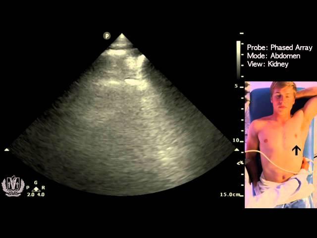 Abdomen: Kidneys & Bladder