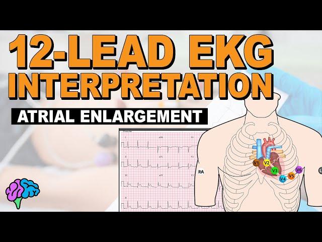 IDENTIFY Atrial Enlargement on 12-Lead EKG