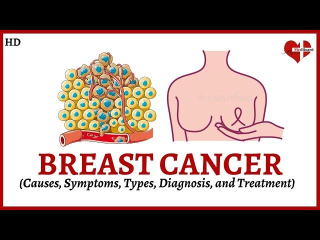 Overview of Breast Cancer:  Causes, Symptoms, Types, and Treatment Explained