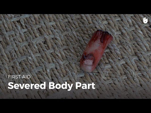 Learn first aid gestures: Severed Body Part