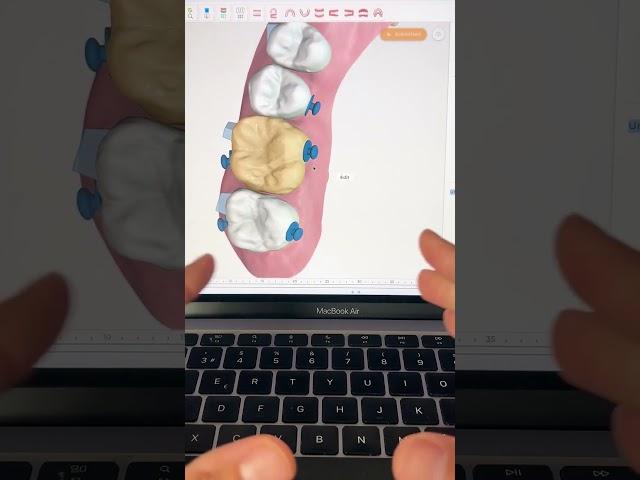 TIP 246 - DISTALISATION + ROTATION WITH MICRO-SCREWS