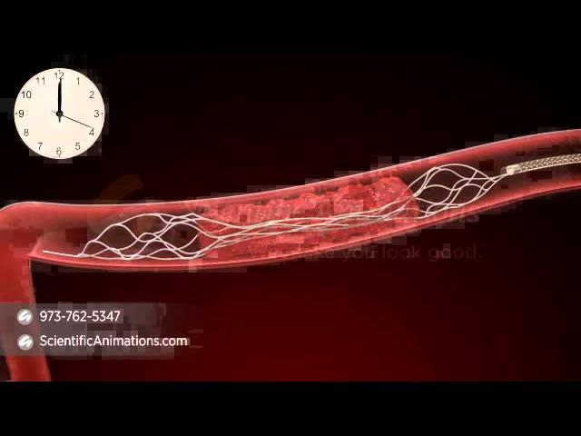 Mechanical Thrombectomy - Neurovascular stent deployment