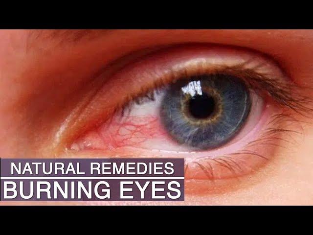 Eye Strain & Burning Eyes Home Remedies | 5 Natural Remedies for Eye Strain, Tired and Burning Eyes|