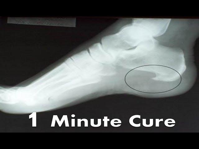 Plantar Fascia Heel Spur Pain [BEST Home Treatment & Remedies!]