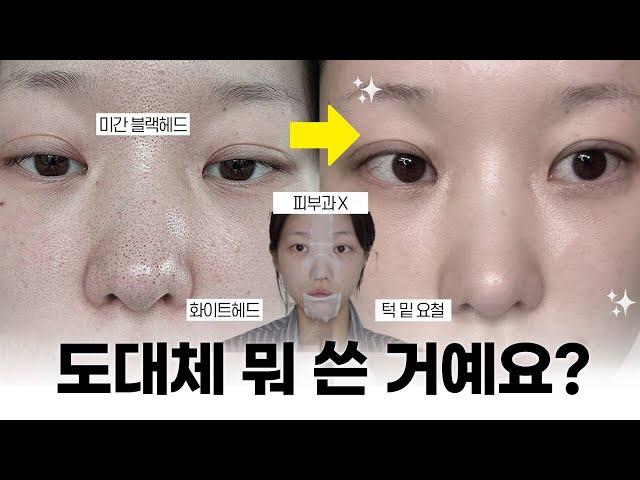 피부과 안 가도됨‍️ '홈케어' 만으로 10분만에 요철+피지 박멸하는 법  (+관리 후 꿀템까지 !) | 소윤Soyoon