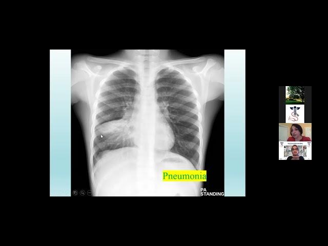 Pediatric Pneumonia Case | TeleShadowing