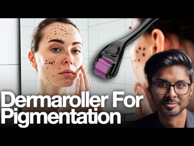 Microneedling For Pigmentation (SAFE At Home Technique)