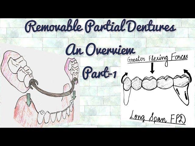 Removable Partial Dentures-An Overview/ Part-1/Indications of RPD