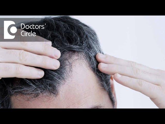 Is it necessary to use minoxidil for transplanted hair? - Dr. Aruna Prasad