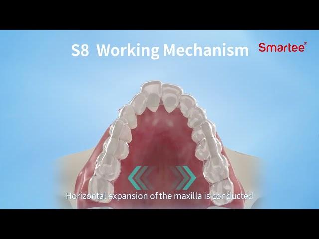 Smartee S8 --- Mandibular Repositioning Technology (SGTB & SGHB)