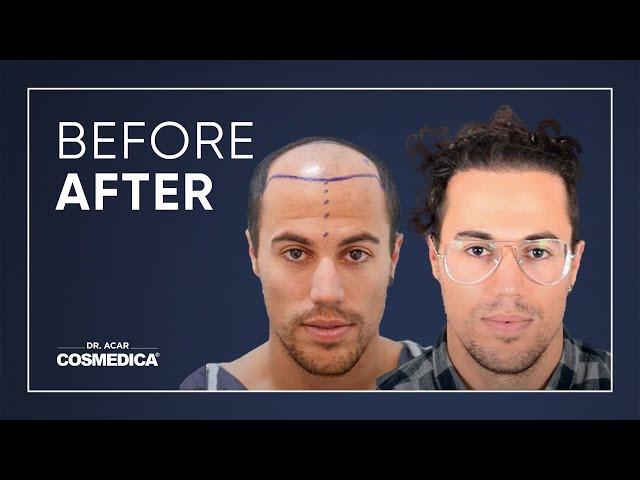 The fascinating change in our patient after his hair transplant surgery.