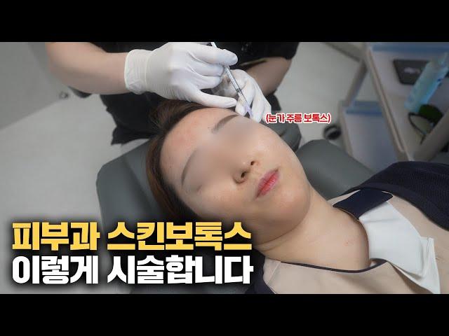 Skin Botox Demonstration: Effective Areas and Safe Practices