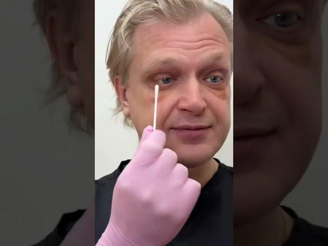 Хирург сделал себе подтяжку! какой результат спустя 12 дней?