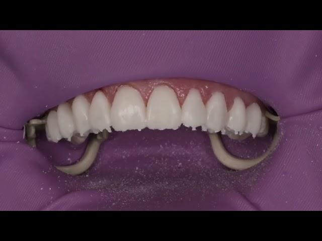 Clinical Tip on veneer temporization