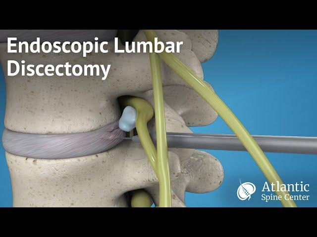 Endoscopic Lumbar Discectomy