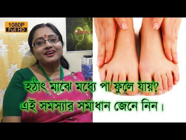 আপনার কি মাঝে মধ্যে পা ফুলে যায়? এই সমস্যার সমাধান জেনে নিন। | EP 135